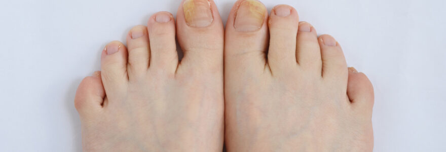 Mycose des ongles